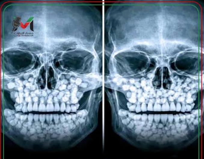 حالة طبية نادرة في البرازيل… طفلة تدهش الأطباء بـ81 سناً داخل فمها